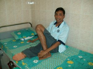 Bpk. Haryono (39 th) salah satu pasien di RS. Kusta Sumberglagah yang diamputasi 10 Juni lalu. 